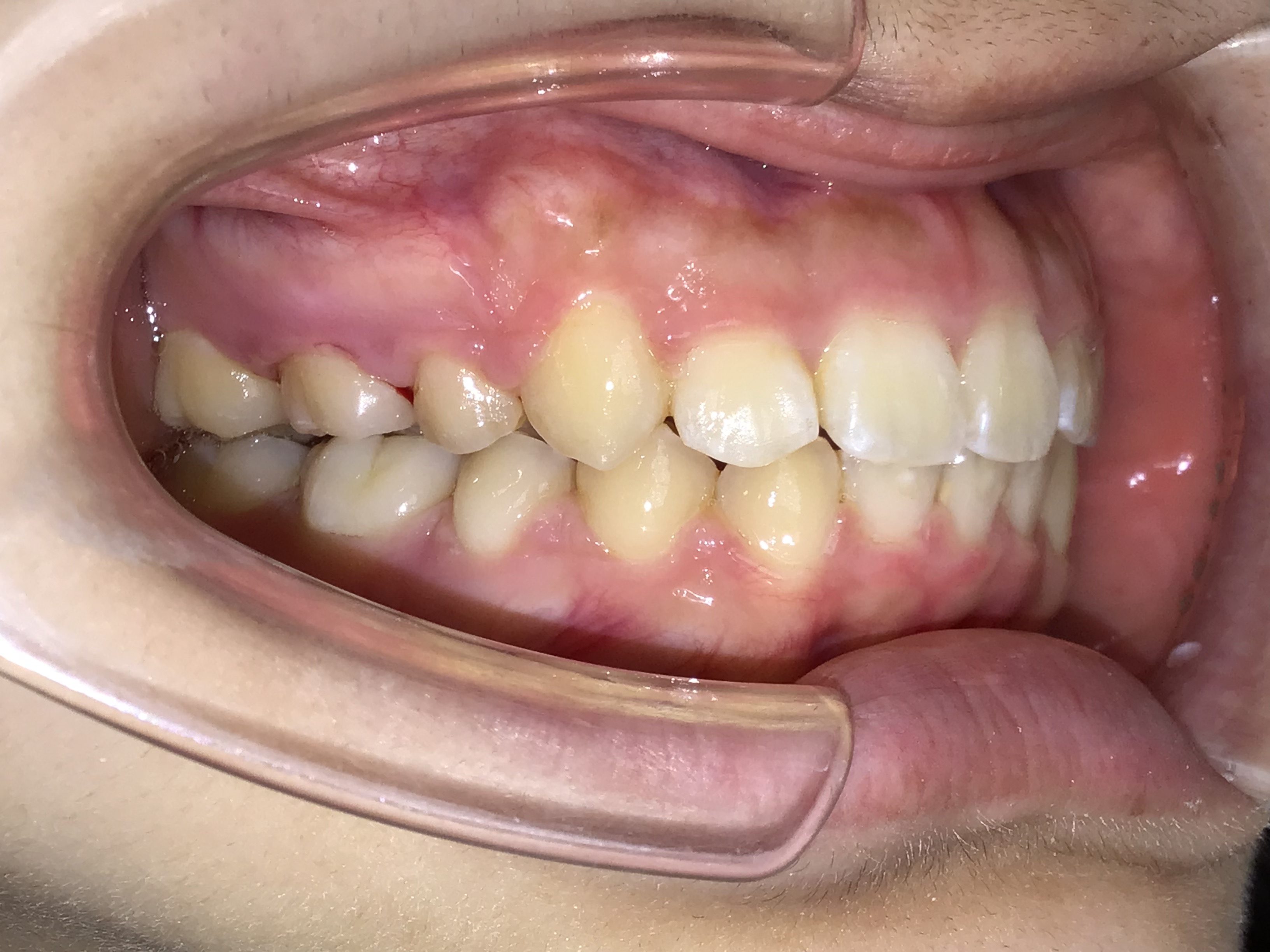 大人の上顎前突 治療後の歯並び