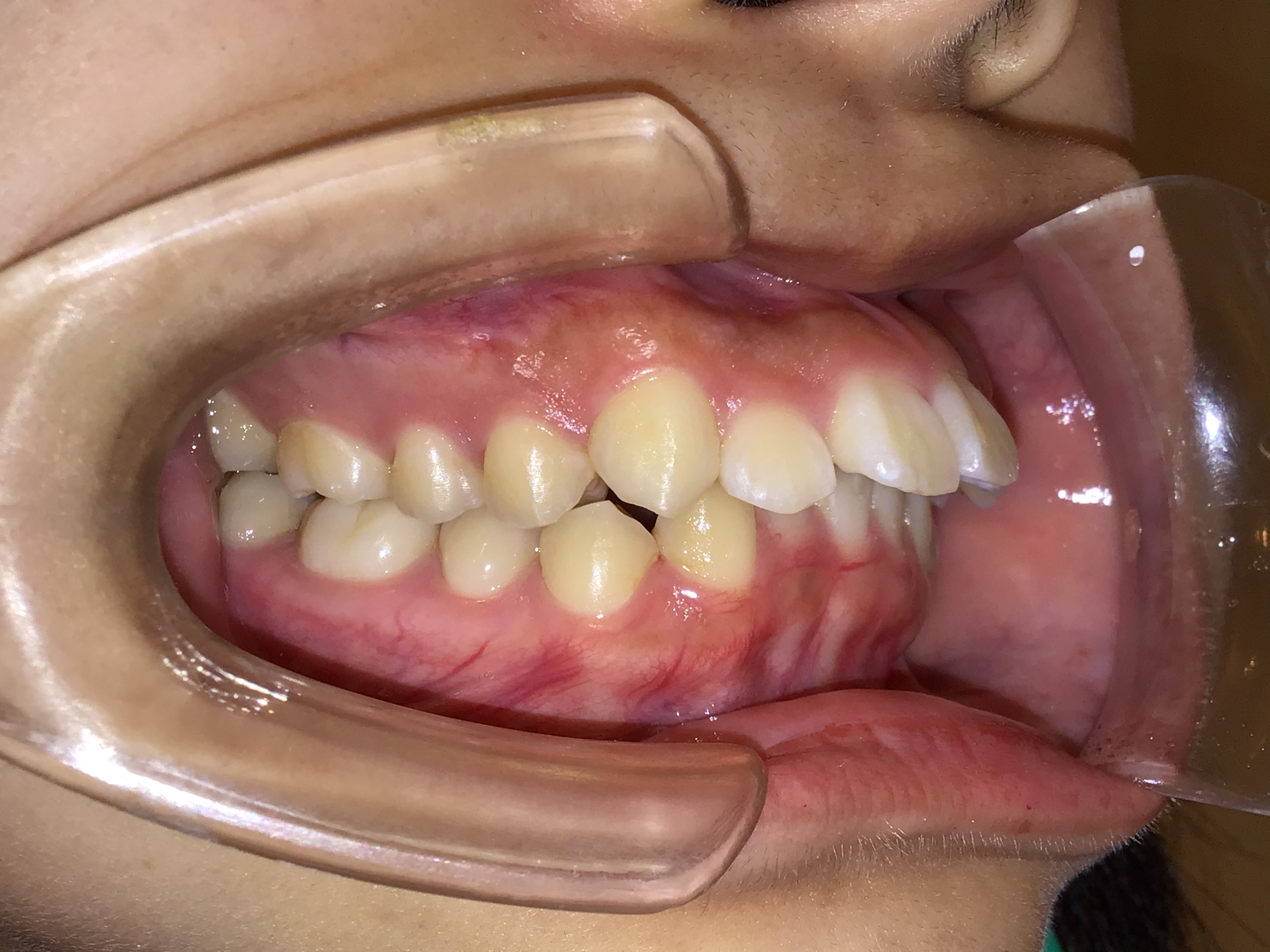 大人の上顎前突 治療前の歯並び