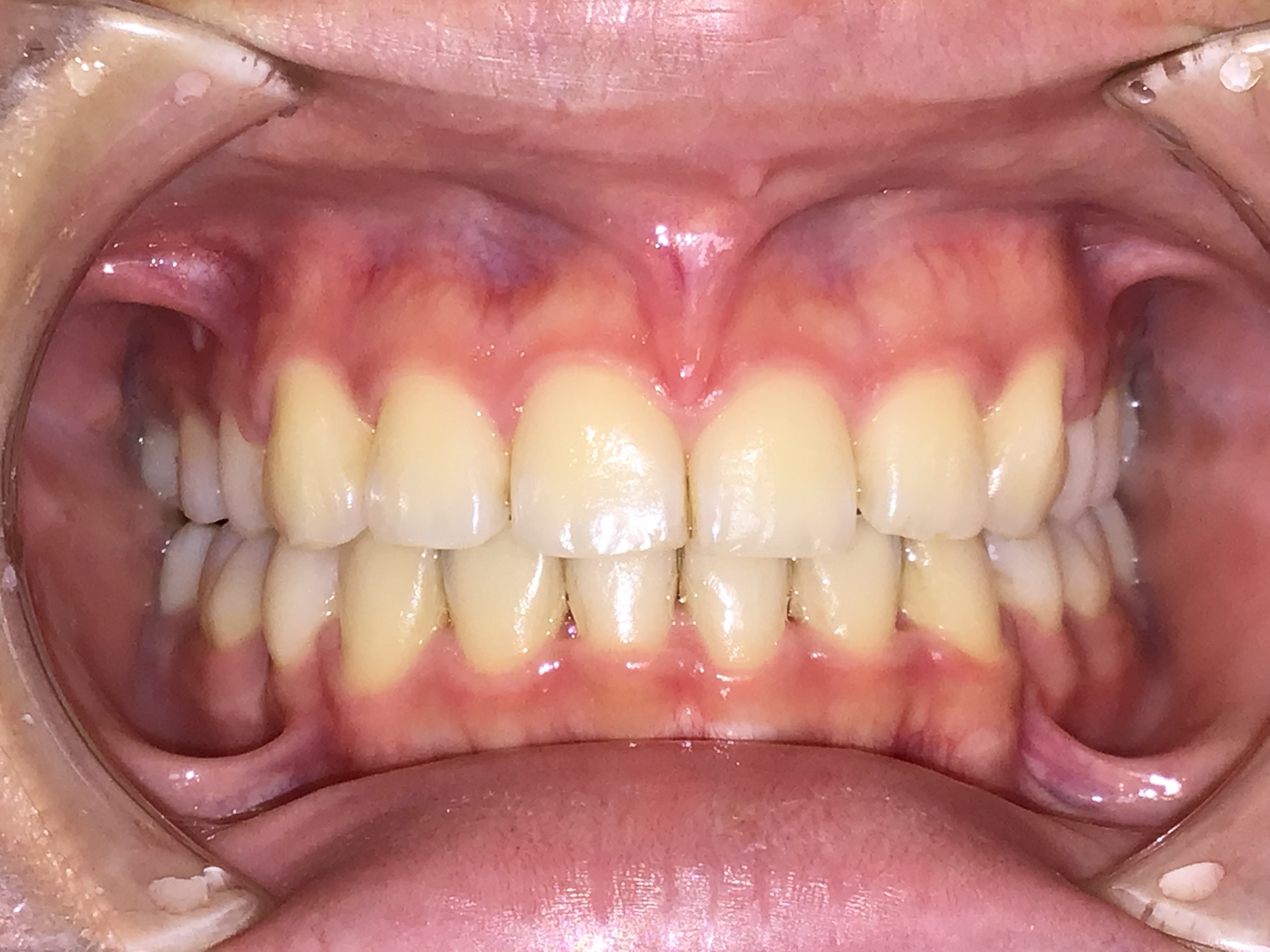 大人の叢生 治療後の歯並び