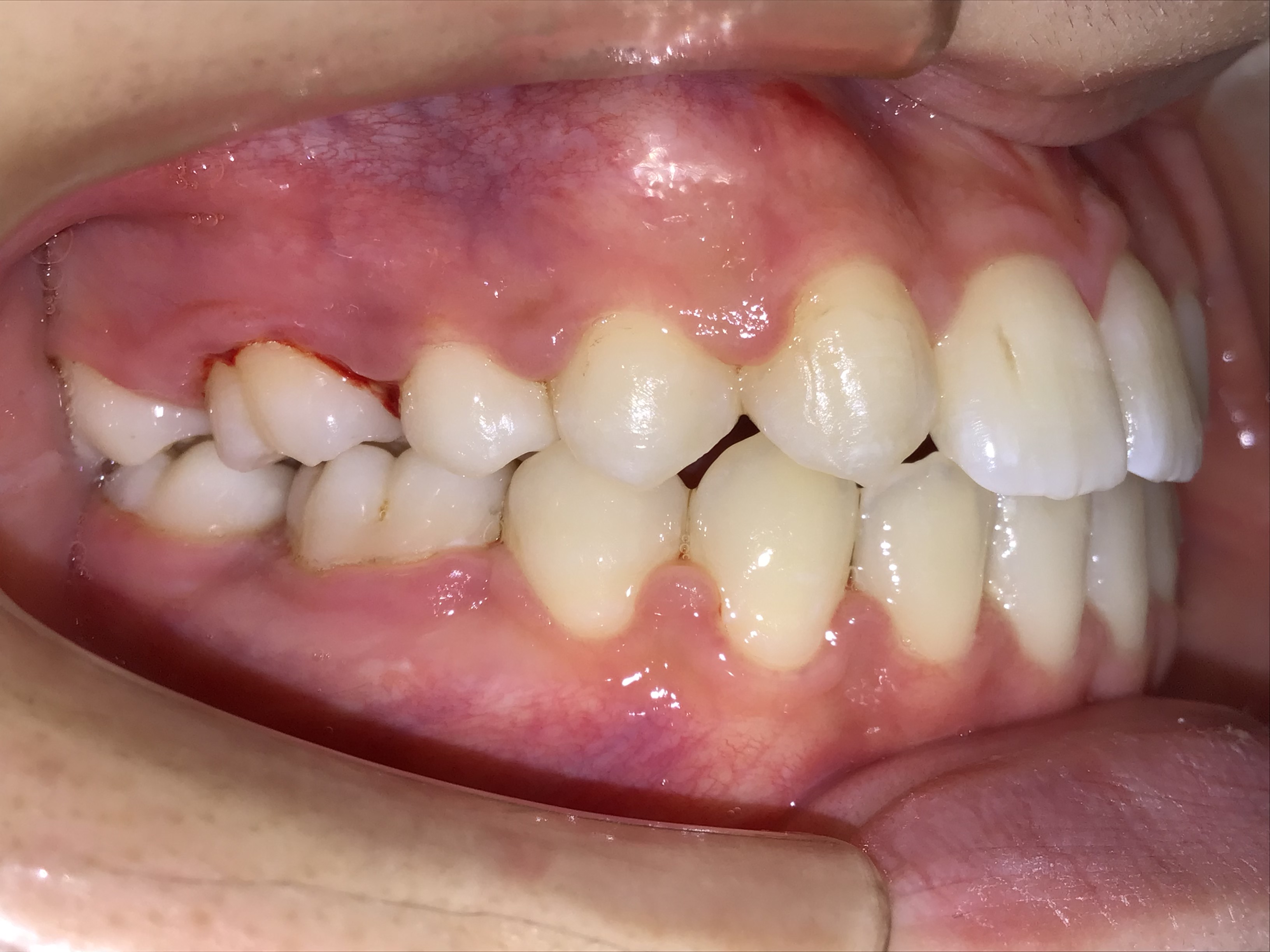 大人の下顎前突 治療後の歯並び